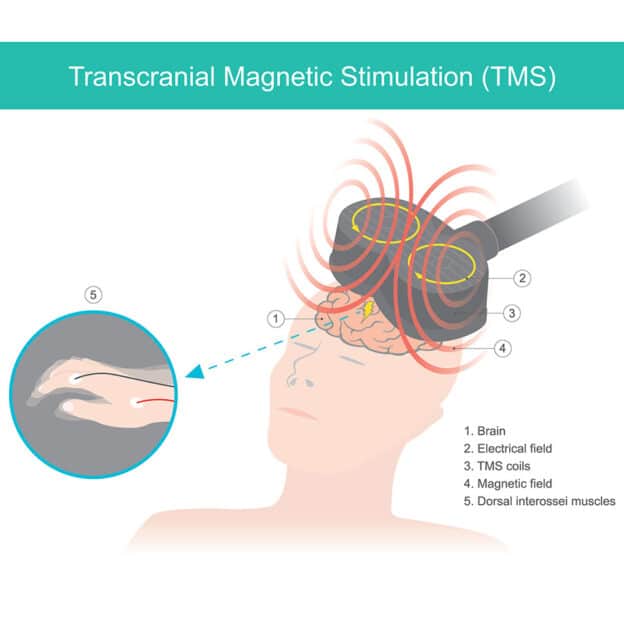 Transcranial Magnetic Stimulation TMS Treatment Near Chicago